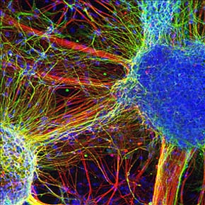 neuronas con esquizofrenia