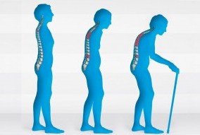La artrosis incrementa el riesgo de caídas y fracturas osteoporóticas en mujeres postmenopáusicas