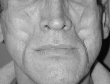 La cirugía para la lipoatrofia facial en pacientes con VIH aún no se aplica en todas las comunidades