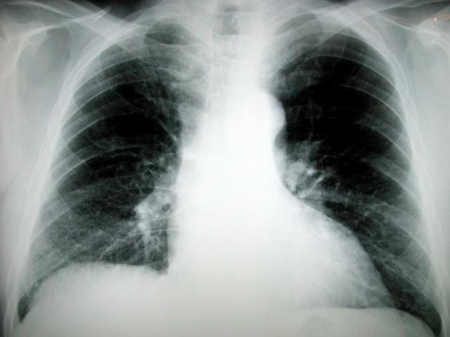 El VIH aumenta el riesgo de sufrir cáncer de pulmón