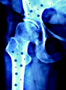 La osteoporosis causa cada año 40.000 fracturas de cadera y 100.000 de vértebra en España