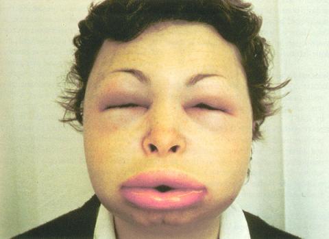 La autoadministración de las terapias para el angioedema hereditario es más barata y eficaz