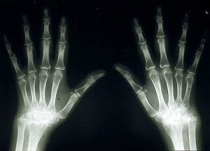 Artritis idiopática juvenil