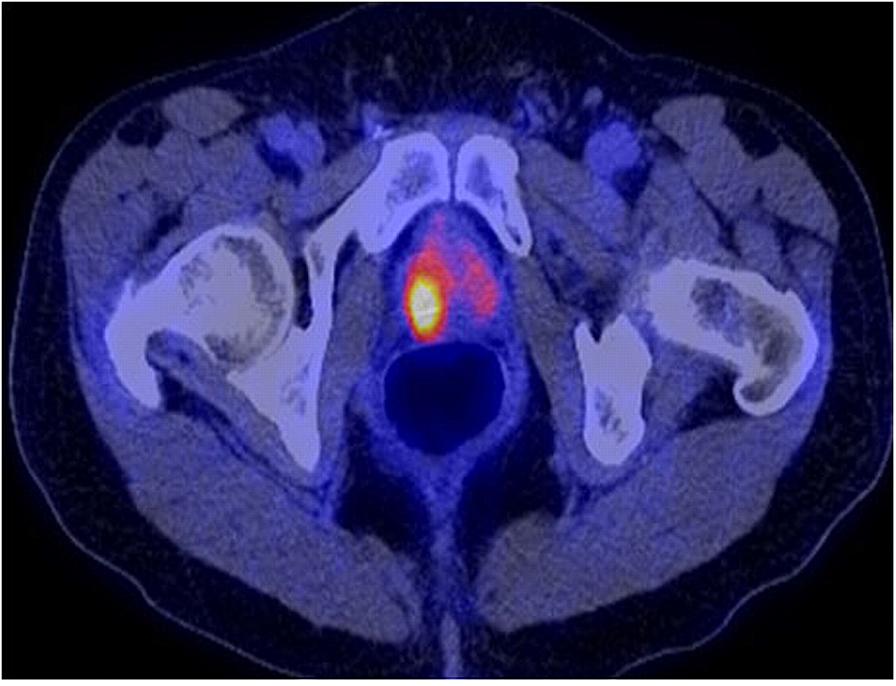 El ácido acetilsalicílico podría reducir la mortalidad por cáncer de próstata