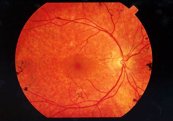 Este domingo, Día Internacional de la Retinosis Pigmentaria