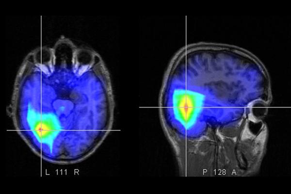 Crece la incidencia de ictus entre la población menor de 55 años