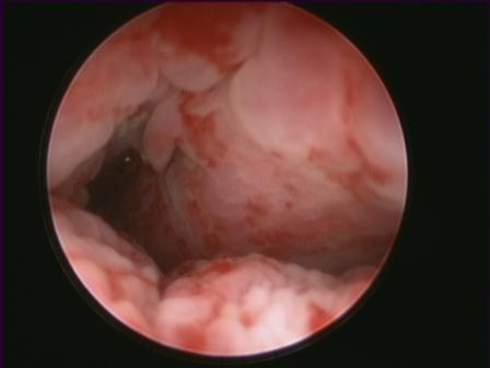 España es el país europeo con mayor incidencia de cáncer de vejiga en varones