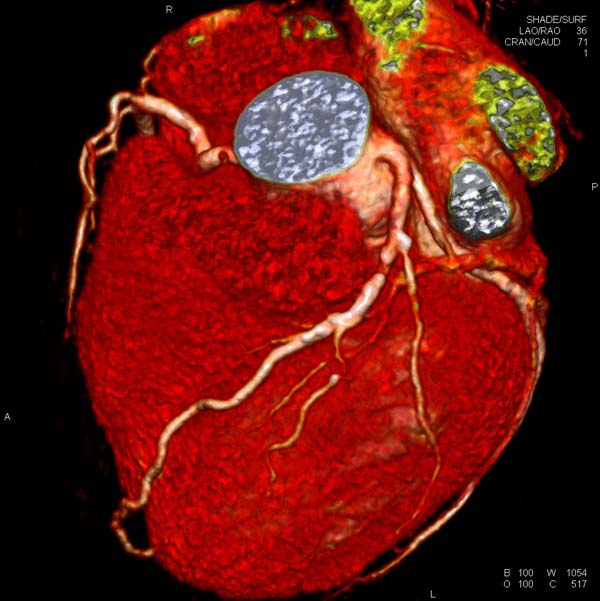 La mortalidad cardiovascular española, muy inferior a la media europea