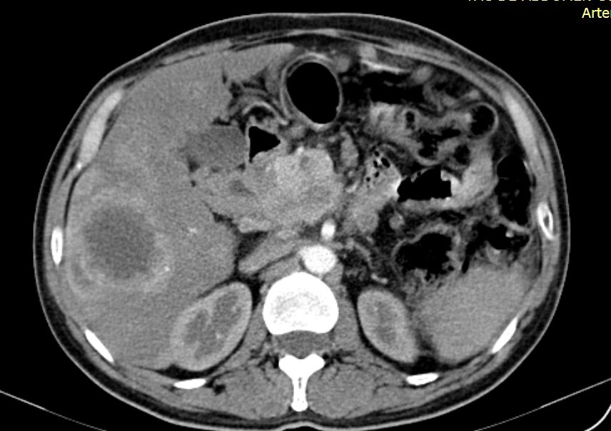 La aspirina disminuye el riesgo de cáncer de hígado y de muerte por EHC