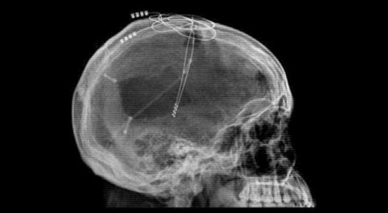 Implantado el primer ‘marcapasos’ cerebral en un paciente con Alzheimer