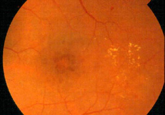 FEDE y Alcon colaboran en la prevención del edema macular en la población diabética