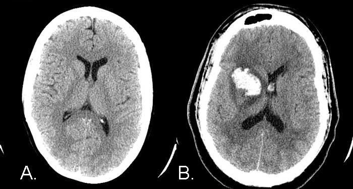 Cerca de 100.000 españoles padecen un accidente cerebrovascular cada año