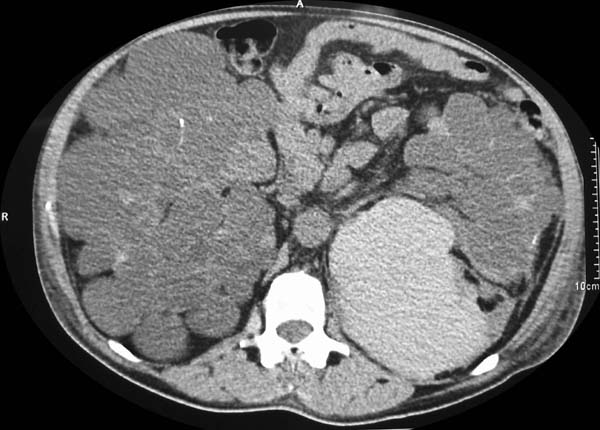 Constituido el comité rector europeo de pacientes con poliquistosis renal autosómica dominante