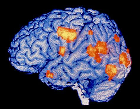 Parkinson, la enfermedad neurodegenerativa con más perspectivas de curación