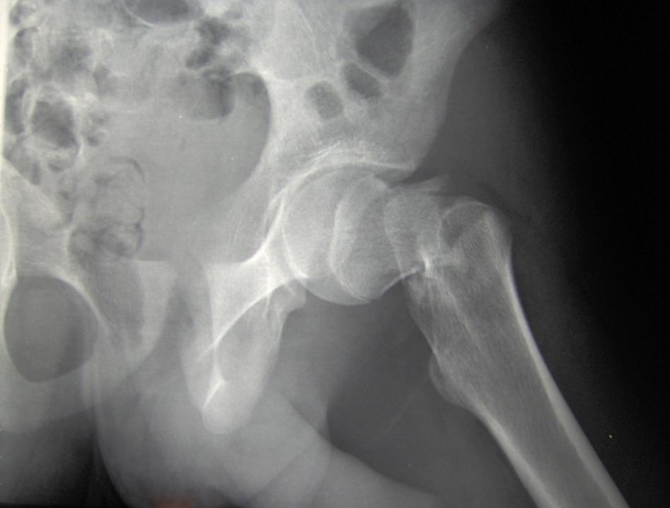 En la próxima década, medio millón de españolas sufrirán una fractura osteoporótica