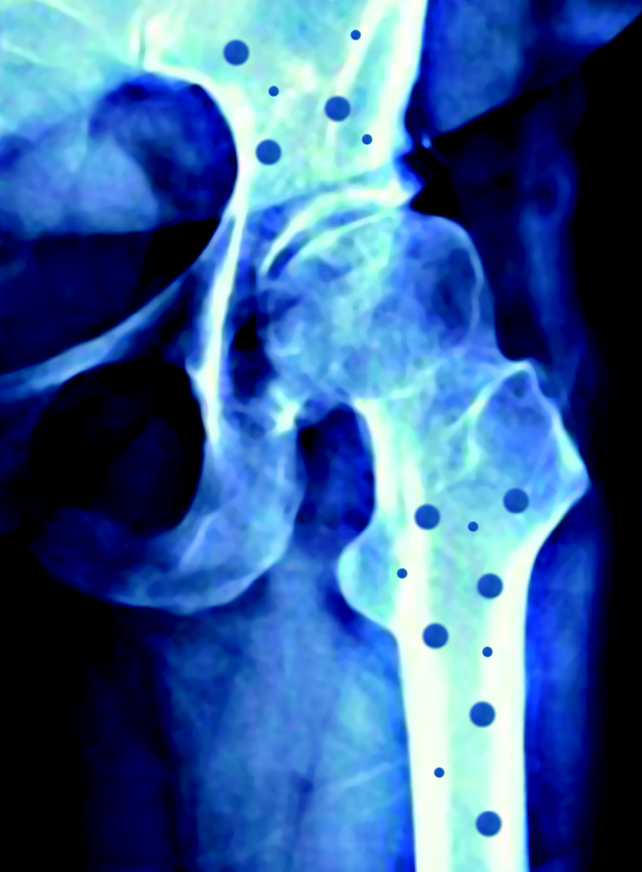 La osteoporosis, poco diagnosticada por falta de formación de los médicos