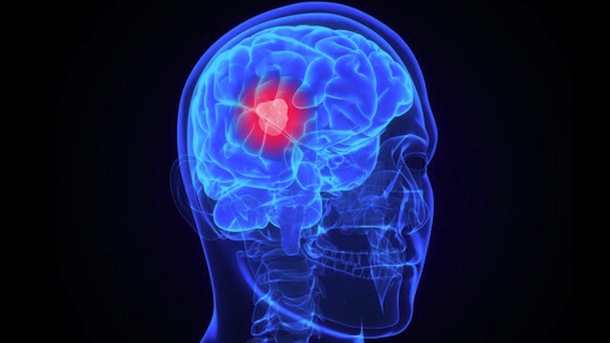 Este sábado se celebra el Día Internacional de los Tumores Cerebrales
