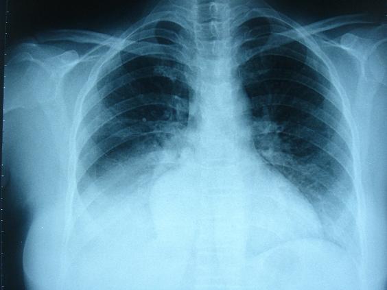 Campaña informativa de ANES sobre la sarcoidosis en hospitales y centros de salud