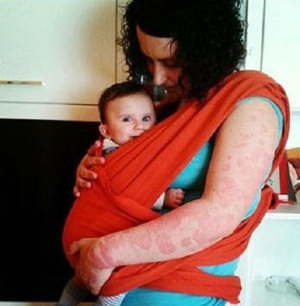 Campaña ‘En verano, tú eres el protagonista’ de Acción Psoriasis