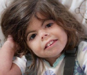 Afectada por el Síndrome de Cornelia de Lange