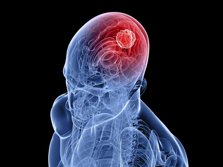 La supervivencia a los tumores cerebrales crece un 11% en los últimos años