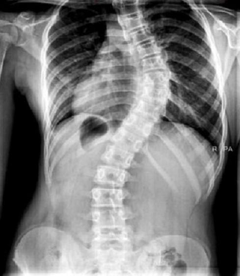 Cerca de un 4% de los niños padece escoliosis no diagnosticada