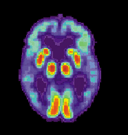 El control de los niveles de colesterol también protege frente al Alzheimer