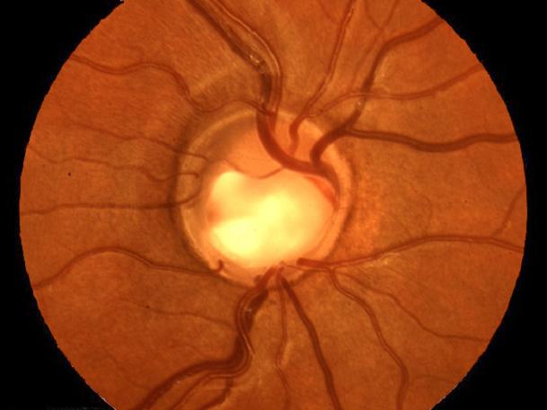 El riesgo de ceguera por glaucoma se ha reducido en un 45% en tres décadas
