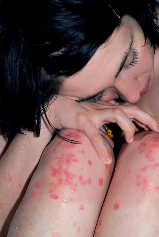 La psoriasis supone un coste de 536 euros al año a cada paciente