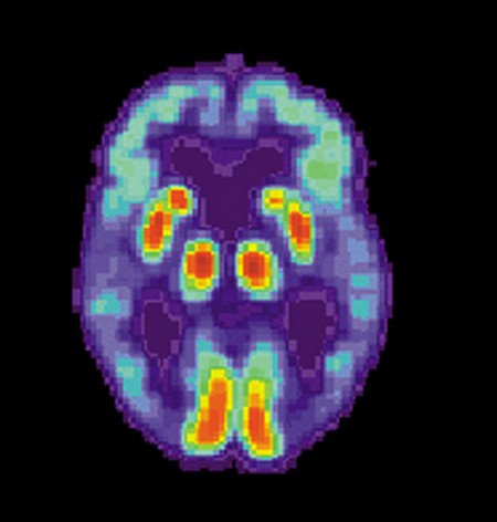 El número de decesos por el Alzheimer podría ser muy superior a lo estimado