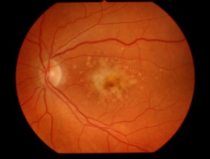 Degeneración macular