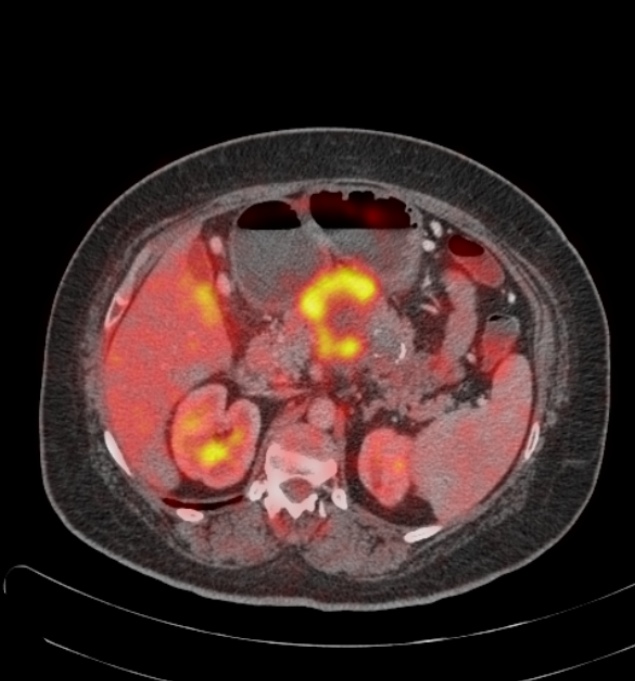 Un nuevo tratamiento para cáncer de páncreas muestra resultados alentadores en ratones