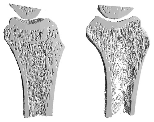 El 80% de las mujeres con osteoporosis desconoce padecer la enfermedad