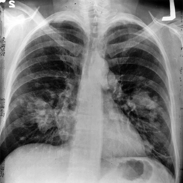Fundación Sandra Ibarra dona 8.000 euros a la investigación en cáncer de pulmón