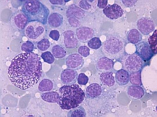 VII Jornadas sobre Mastocitosis de AEDM, mañana en Madrid