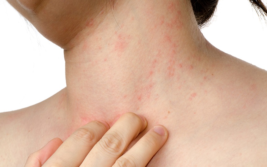 Los médicos de Primaria diagnostican hasta un 25% de los casos de psoriasis