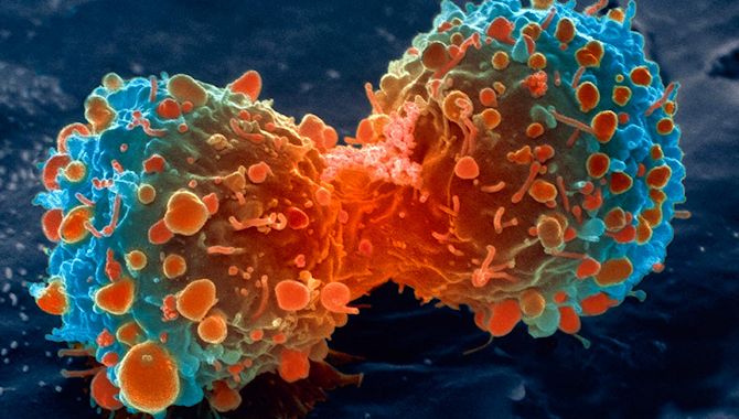 La mortalidad por cáncer continúa disminuyendo en la Unión Europea