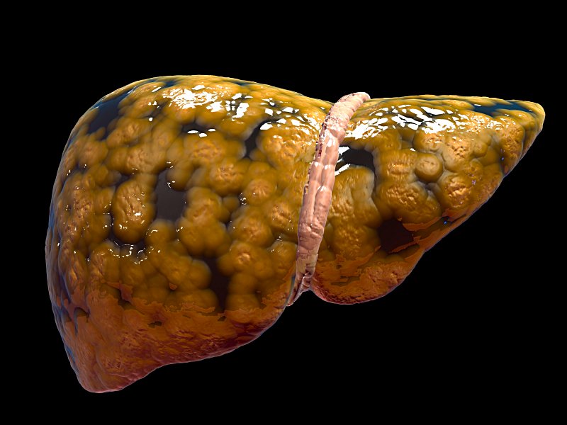 El hígado graso es un factor de riesgo de enfermedad cardiovascular