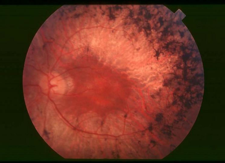 Manifiesto de FARPE por el Día Mundial de la Retinosis Pigmentaria