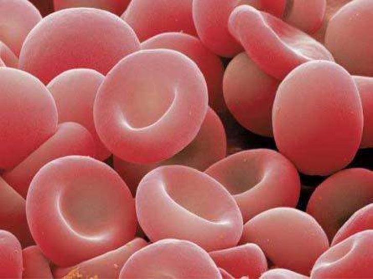 Los adultos con anemia tienen mayor riesgo de pérdida auditiva
