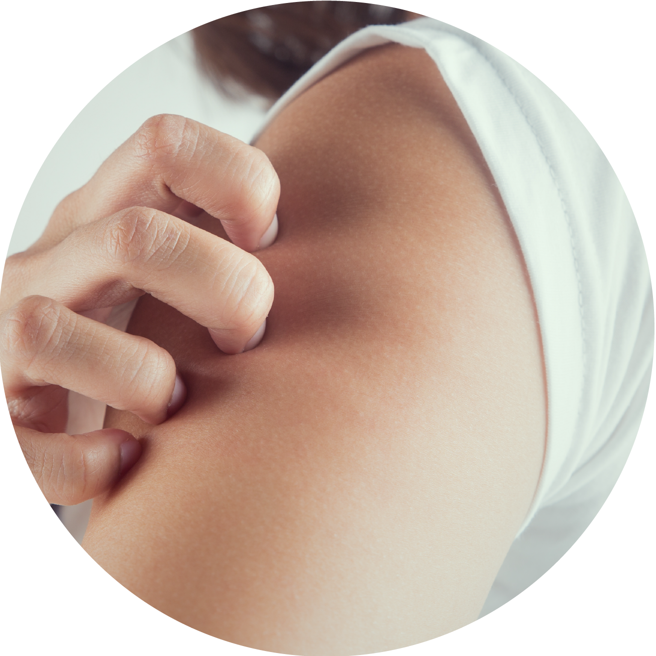 Dermatitis atópica, mucho más que un picor