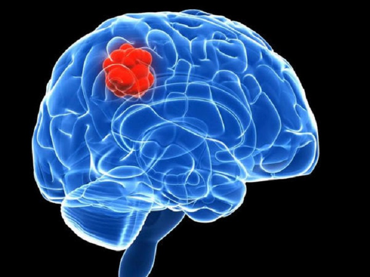 Hoy viernes, 8 de junio, se celebra el Día Internacional de los Tumores Cerebrales
