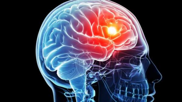 El tratamiento ‘ultratemprano’ es crucial para reducir el impacto del ictus