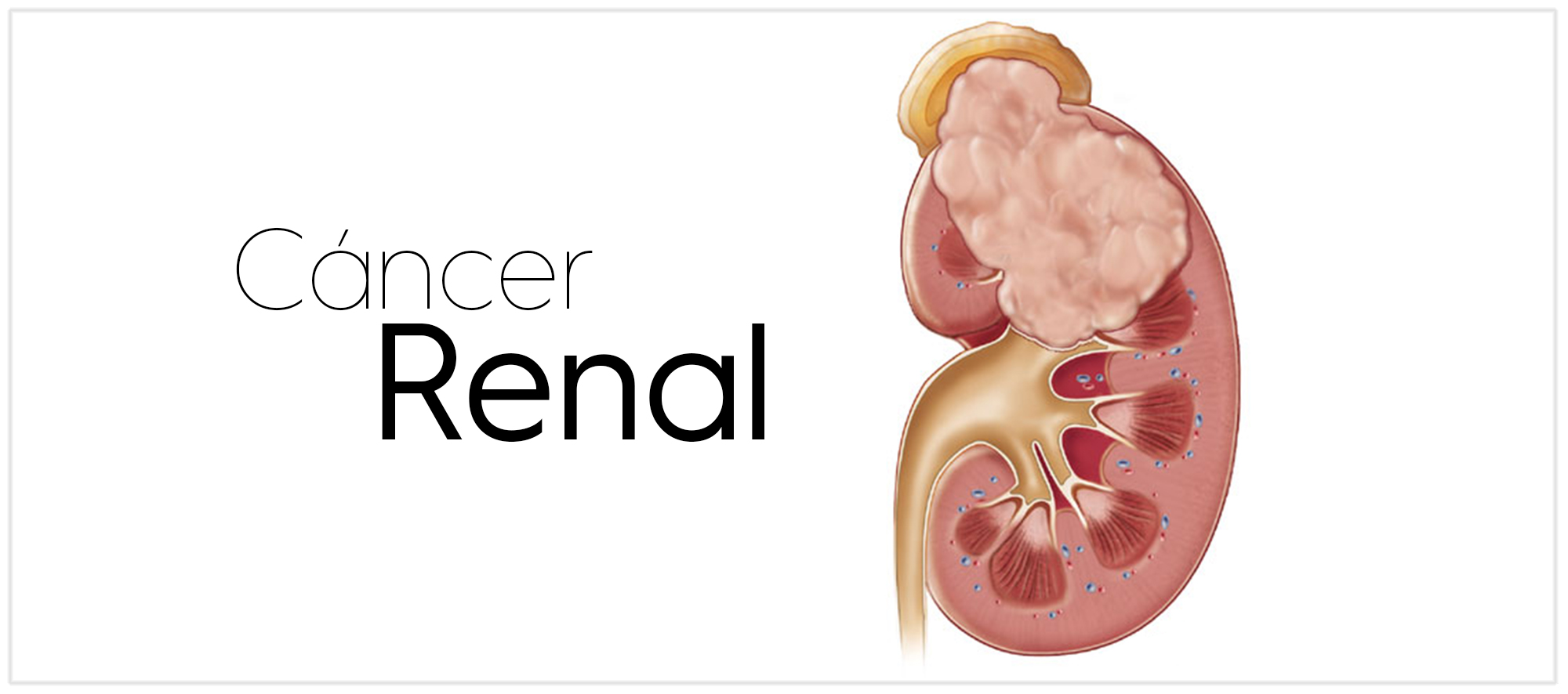 La secuenciación terapéutica logra supervivencias superiores a treinta meses en cáncer renal avanzado