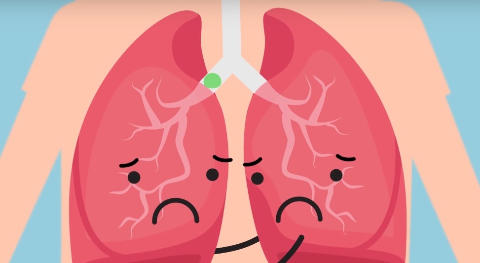 Por unos estándares europeos en el tratamiento de la fibrosis quística