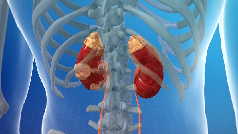 Encuesta para mejorar la atención en el cáncer renal