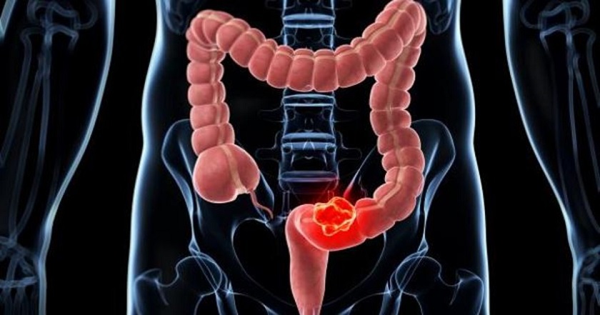 Conviviendo con el cáncer de colon