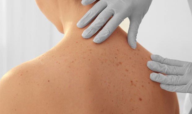 Melanoma: Visión 360º