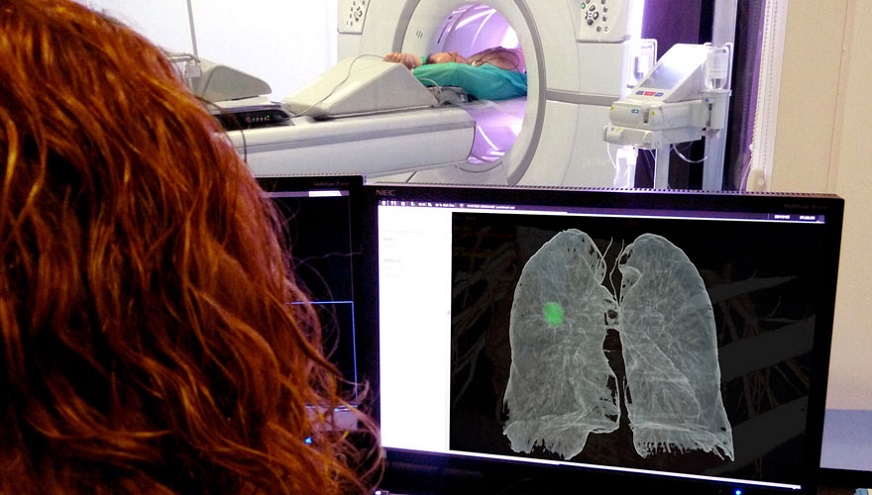 Implantar sin más demoras el cribado del cáncer de pulmón