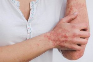 Los pacientes con enfermedad psoriásica perciben falta de atención a su vida sexual y salud mental